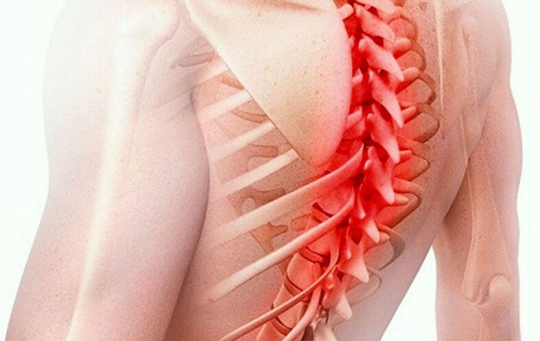 остеохондроз грудного отдела позвоночника